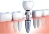 Oral Surgery: Advanced Procedures for Restoring Oral Health and Function