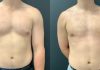 Maintaining Long-Term Results After Gynecomastia Surgery