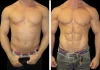 Are The Results Of An Abdominal Etching Permanent